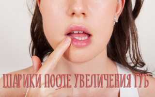 Что делать, если появились шарики в губах после Гиалуроновой кислоты?
