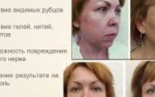 Как делается эндоскопическая подтяжка лба и бровей
