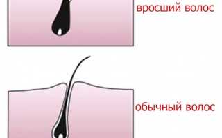 Как убрать раздражение после шугаринга в зоне бикини, как лечить