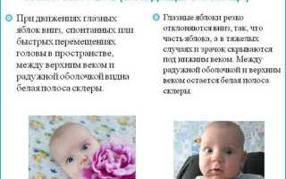 Симптом заходящего солнца у новорожденных: причины и выявление синдрома