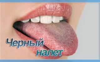 Причины и опасности образования черного налета на языке