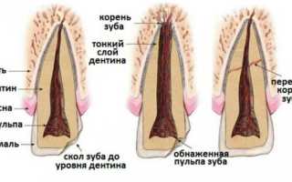 Восстановление сломанного переднего зуба — как нарастить фронтальный зубной ряд?