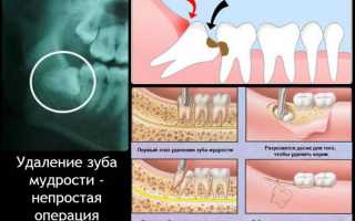 Этапы заживления лунки после удаления зуба и возможные осложнения