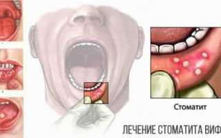 Обзор 10 лучших лекарств по лечению вирусного стоматита у ребенка