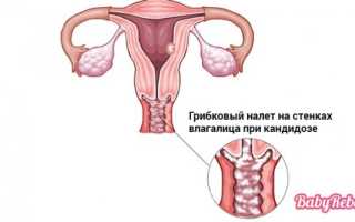 Молочница у женщин и мужчин: лечение, причины, симптомы